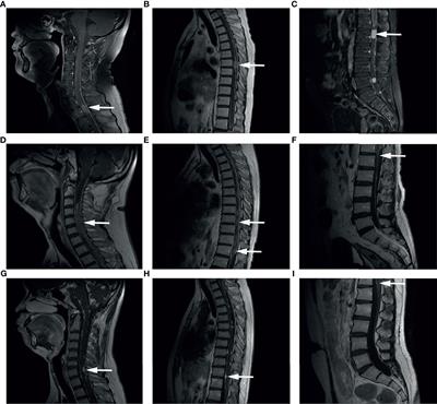 A Retrospective Study on Spinal Dissemination of Supratentorial Glioma